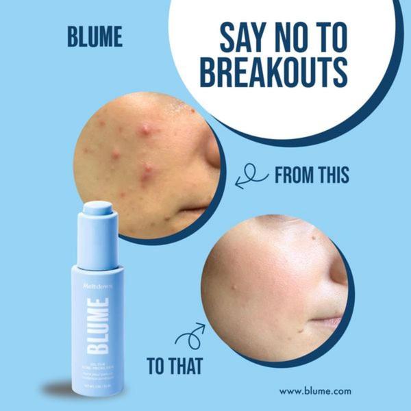 acne treatment, skincare serum, blemish control, breakout treatment, skin care product, facial treatment, anti-acne serum, product launch, social proof, minimalist, trustworthy, fresh, blue