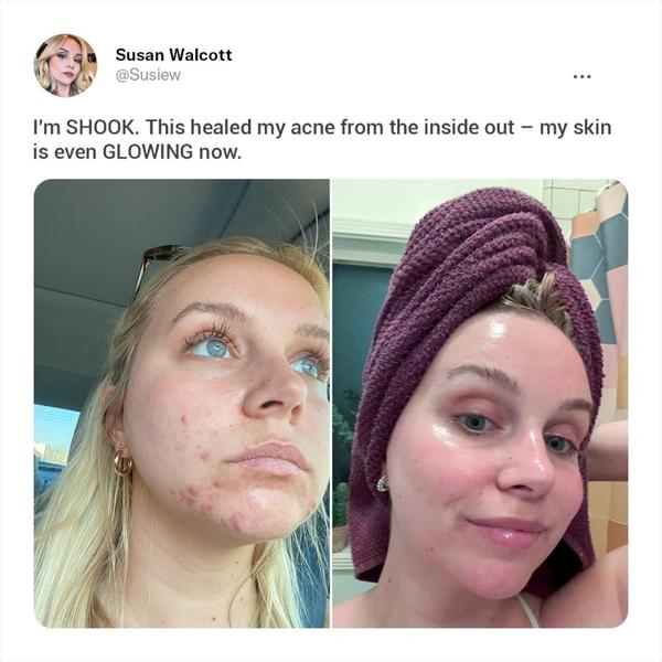 skincare treatment, acne treatment, facial treatment, skin care product, beauty treatment, complexion treatment, anti-acne product, social proof, ugc style, trustworthy, neutral