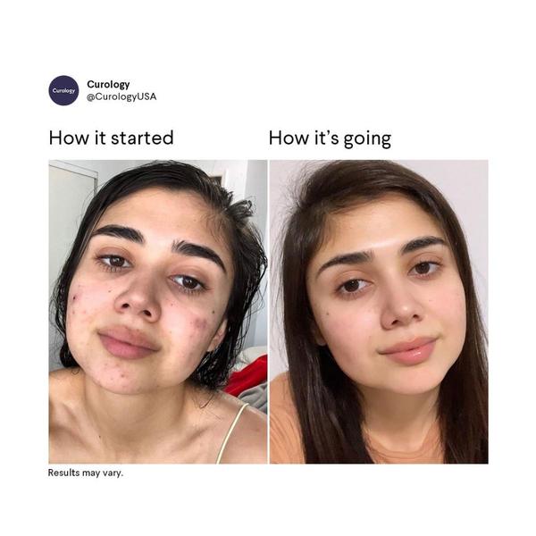 skincare products, acne treatment, face care, skin treatment, beauty products, cosmetics, facial care, social proof, ugc style, trustworthy, neutral