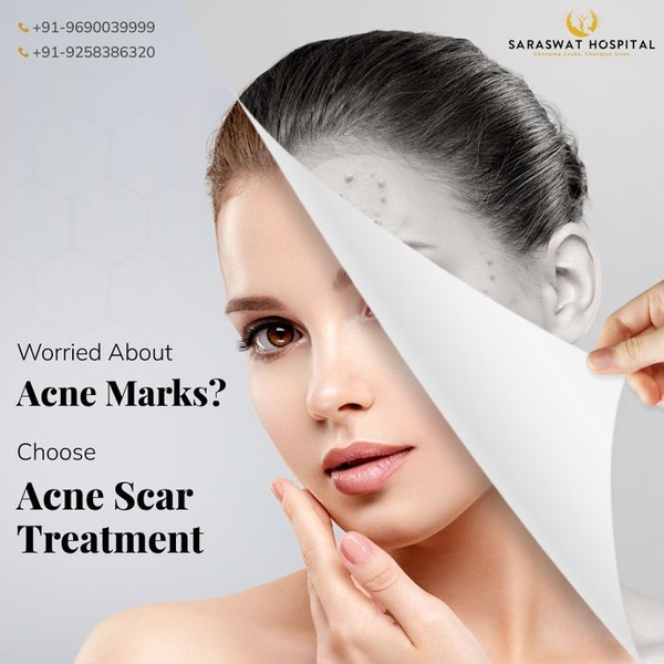 acne scar treatment, scar removal treatment, acne mark treatment, skin treatment, dermatology treatment, facial treatment, cosmetic treatment, brand awareness, minimalist, trustworthy, calm, neutral