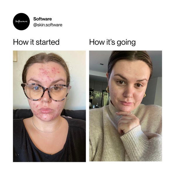 skincare products, acne treatment, skin care, facial treatment, beauty products, cosmetics, skincare routine, social proof, ugc style, trustworthy, neutral