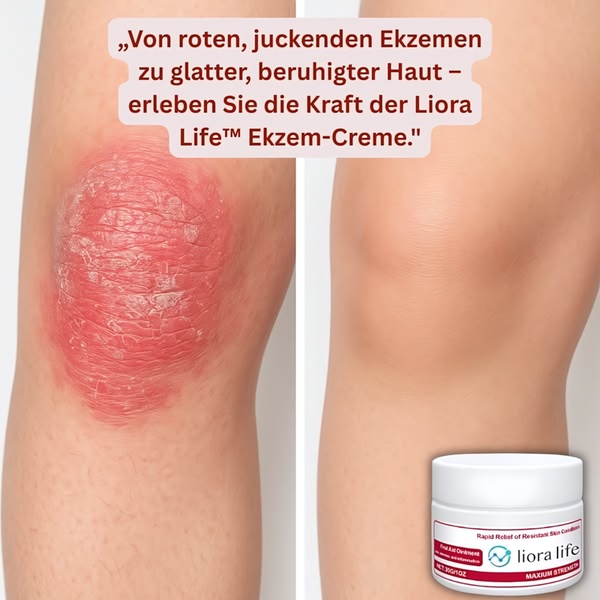 A split-screen comparison showing the skin healing journey from an inflamed, red patch to smooth, healthy skin after using the cream.