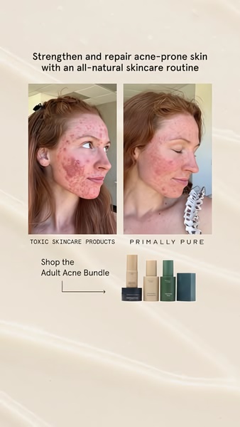 skincare set, acne treatment, face care kit, skincare routine, beauty bundle, facial products, skin treatment, social proof, bundle offer, ugc style, trustworthy, neutral