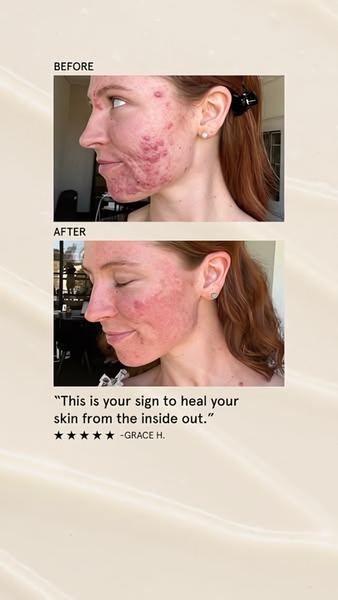skin care, acne treatment, skincare products, facial treatment, skin healing, dermatology products, skin therapy, social proof, ugc style, trustworthy, neutral