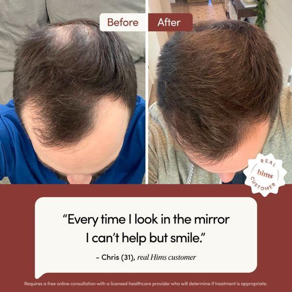 A square-format comparative ad showing a user's hair density improvement alongside a personal testimonial quote.
