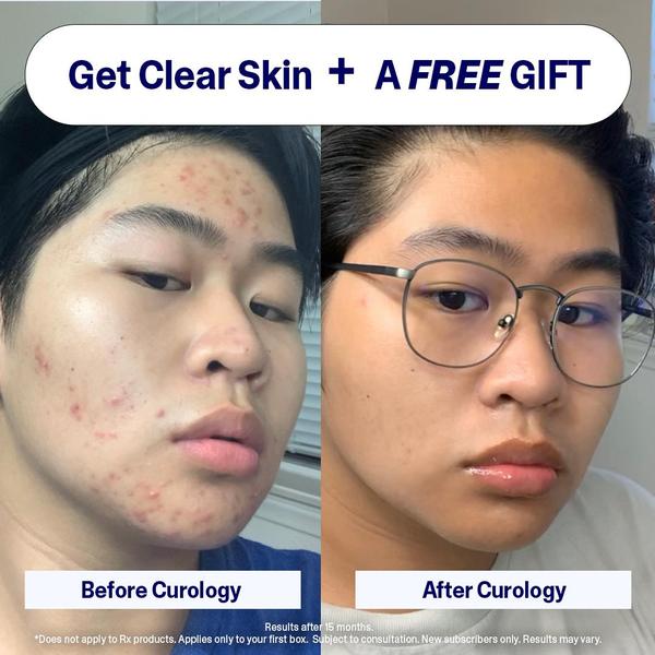 acne treatment, skin care, acne products, clear skin, skincare routine, blemish treatment, face care, social proof, free shipping, ugc style, trustworthy, blue, neutral