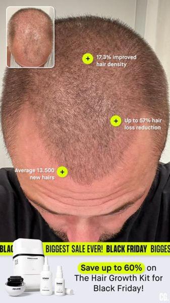 A close-up before and after transformation shot highlighting specific hair density improvements and percentage-based success metrics.