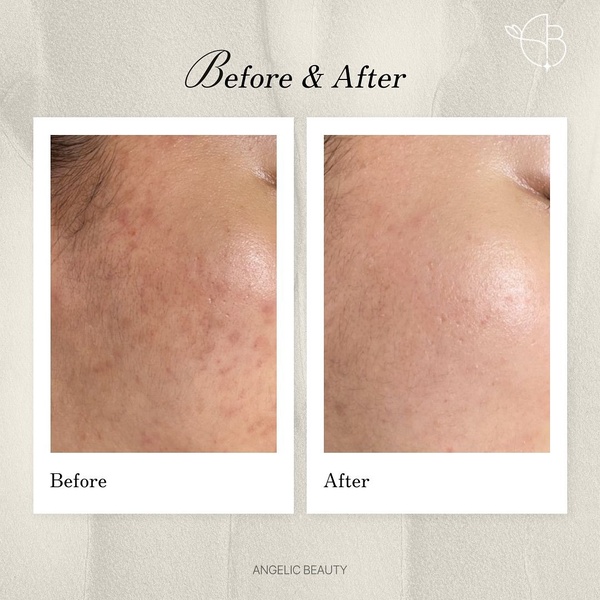 A split-screen comparison showing the texture and tone improvement of skin before and after using a beauty product.