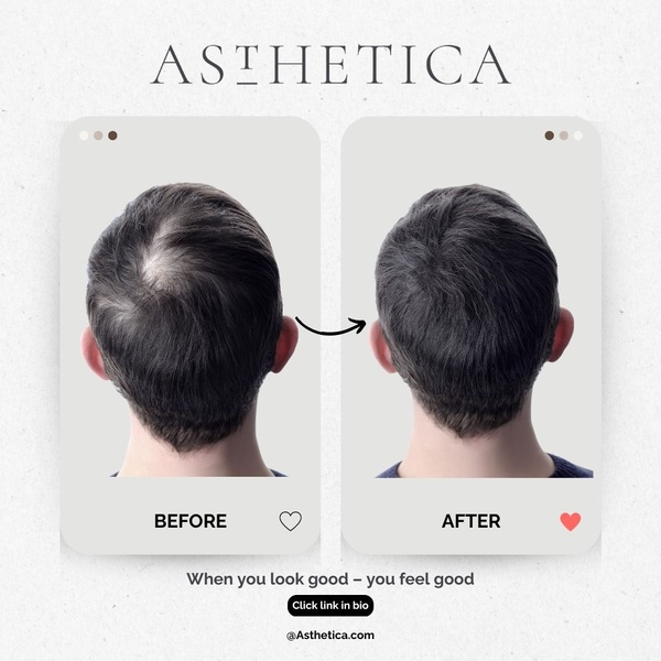 A high-contrast side-by-side image showing hair density improvement to build trust in a hair growth solution.