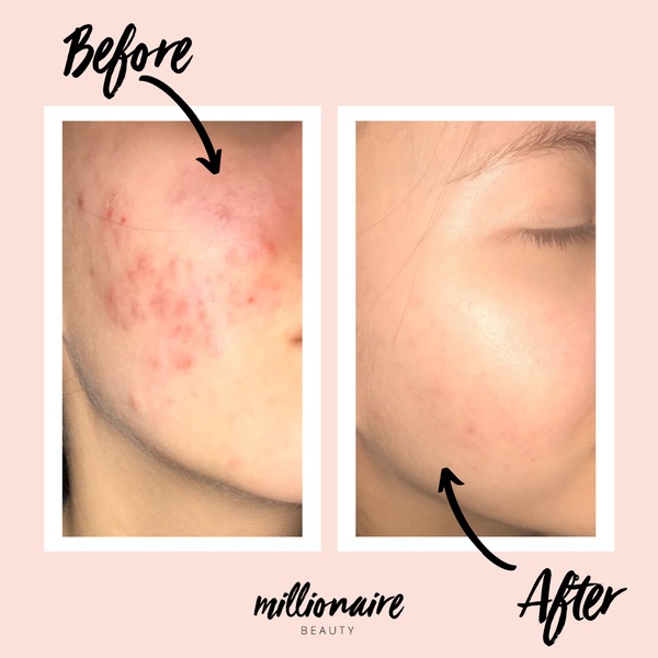 A split-screen comparison showing significant improvement in skin texture and acne reduction for a beauty treatment.